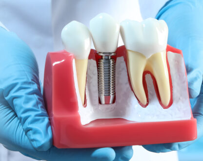 In Reality, How Long do Dental Implants Last?