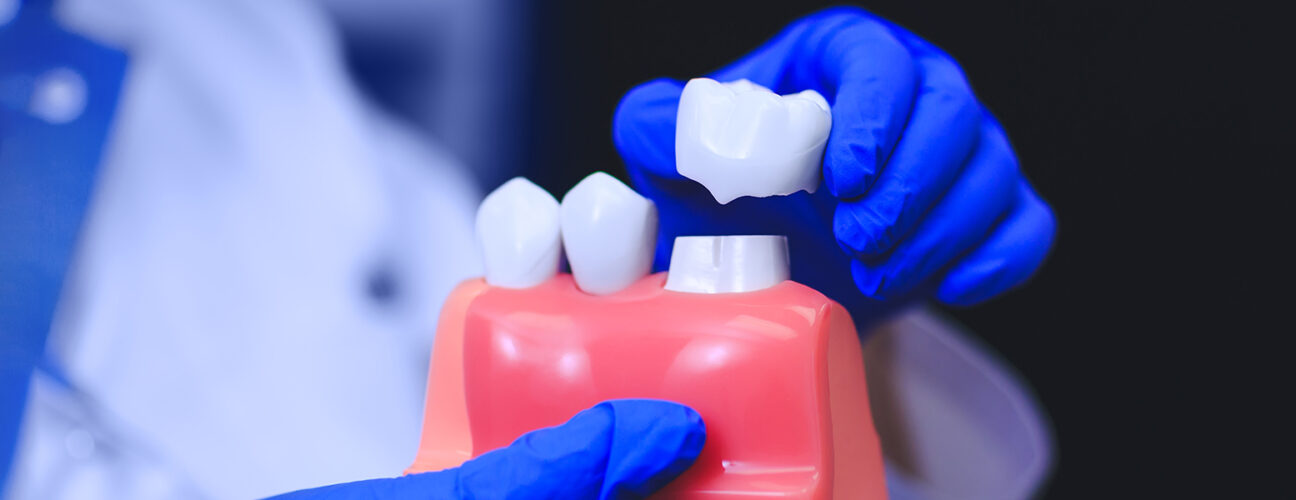 Top 5 Reasons to Choose Dental Crowns for Tooth Restoration