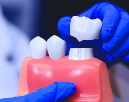 Top 5 Reasons to Choose Dental Crowns for Tooth Restoration