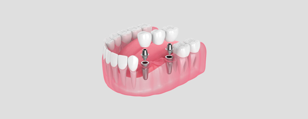 7 Tips for Supporting Healing After Dental Bridge Placement