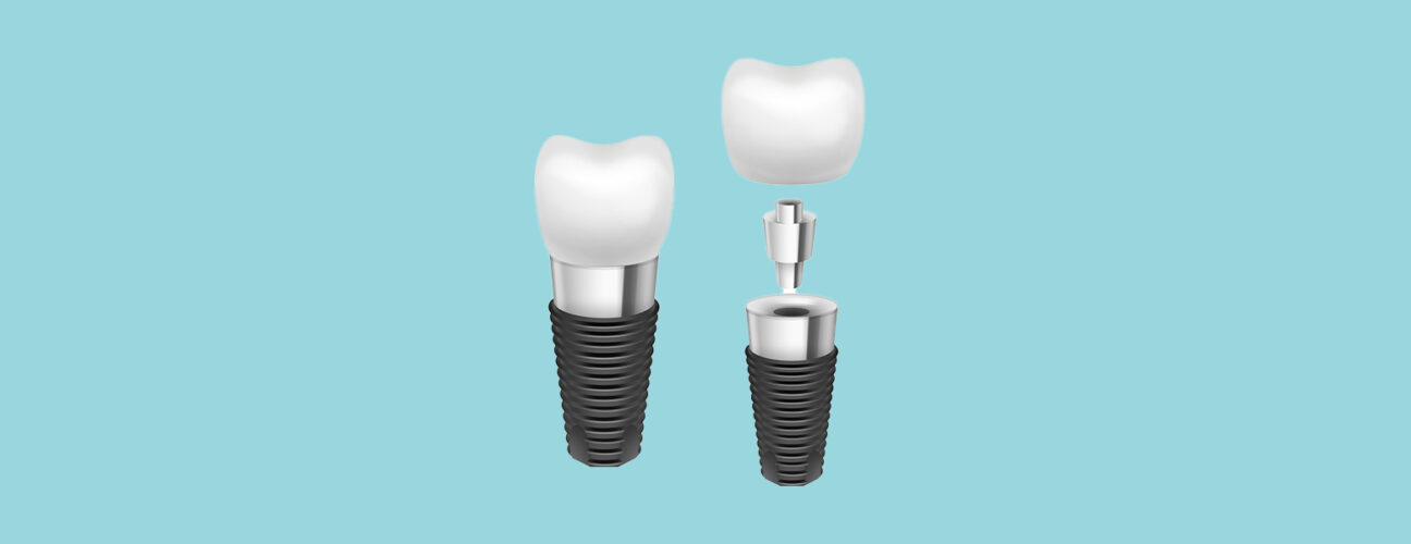 8 Common Misconceptions About Dental Implants in Chicago