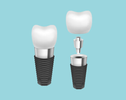 8 Common Misconceptions About Dental Implants in Chicago