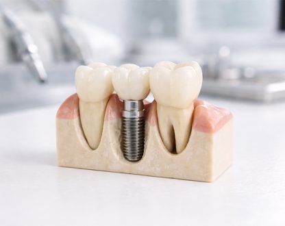 8 Frequently Asked Questions About Dental Implants